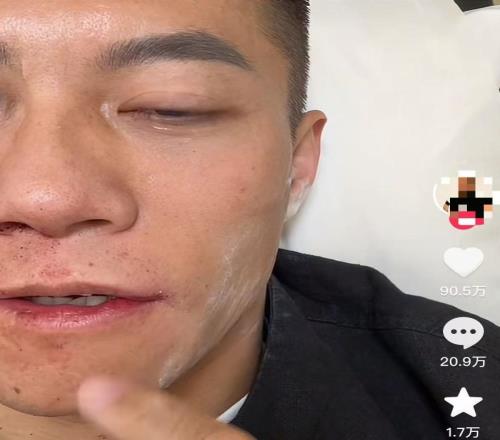 扇耳光大賽倒地的中國選手再發(fā)聲：眼睛不時(shí)疼痛，仍希望參賽